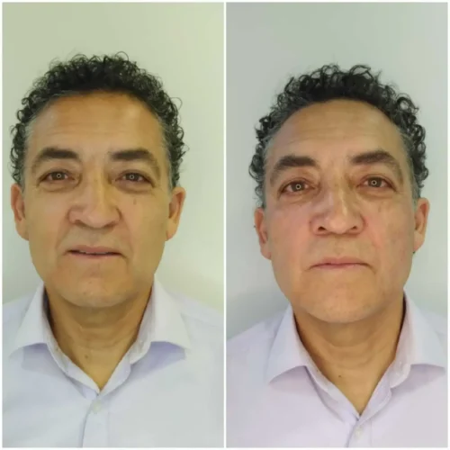 testimoniobotox